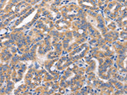 The image on the left is immunohistochemistry of paraffin-embedded Human thyroid cancer tissue using CSB-PA680389(CARD17 Antibody) at dilution 1/50, on the right is treated with synthetic peptide. (Original magnification: ×200)