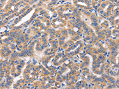 The image on the left is immunohistochemistry of paraffin-embedded Human thyroid cancer tissue using CSB-PA680389(CARD17 Antibody) at dilution 1/50, on the right is treated with synthetic peptide. (Original magnification: ×200)