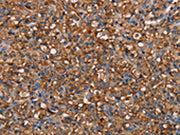 The image on the left is immunohistochemistry of paraffin-embedded Human prostate cancer tissue using CSB-PA680788(NEDD4L Antibody) at dilution 1/60, on the right is treated with fusion protein. (Original magnification: ×200)