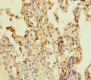 Immunohistochemistry of paraffin-embedded human lung cancer using CSB-PA681476LA01HU at dilution of 1:100