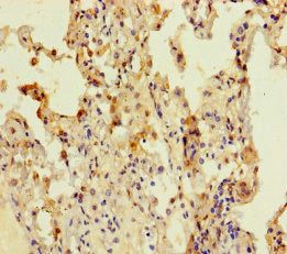 Immunohistochemistry of paraffin-embedded human lung cancer using CSB-PA681476LA01HU at dilution of 1:100