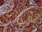 IHC image of CSB-PA681513LA01HU diluted at 1:600 and staining in paraffin-embedded human cervical cancer performed on a Leica BondTM system. After dewaxing and hydration, antigen retrieval was mediated by high pressure in a citrate buffer (pH 6.0)...