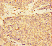 Immunohistochemistry of paraffin-embedded human ovarian cancer using CSB-PA681515LA01HU at dilution of 1:100