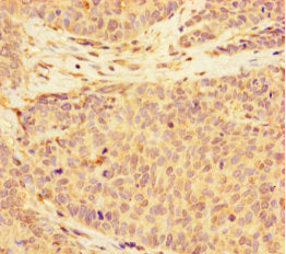 Immunohistochemistry of paraffin-embedded human ovarian cancer using CSB-PA681515LA01HU at dilution of 1:100