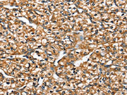 The image on the left is immunohistochemistry of paraffin-embedded Human prostate cancer tissue using CSB-PA681533(SLC26A5 Antibody) at dilution 1/20, on the right is treated with synthetic peptide. (Original magnification: ×200)