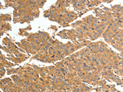 The image on the left is immunohistochemistry of paraffin-embedded Human liver cancer tissue using CSB-PA681598(TNN Antibody) at dilution 1/50, on the right is treated with synthetic peptide. (Original magnification: ×200)
