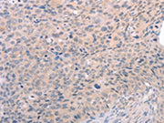 The image on the left is immunohistochemistry of paraffin-embedded Human cervical cancer tissue using CSB-PA682555(S1PR3 Antibody) at dilution 1/30, on the right is treated with synthetic peptide. (Original magnification: ×200)