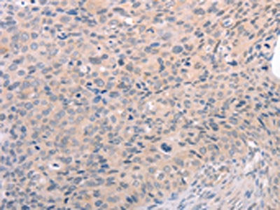 The image on the left is immunohistochemistry of paraffin-embedded Human cervical cancer tissue using CSB-PA682555(S1PR3 Antibody) at dilution 1/30, on the right is treated with synthetic peptide. (Original magnification: ×200)