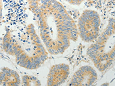The image on the left is immunohistochemistry of paraffin-embedded Human colon cancer tissue using CSB-PA683235(TP53BP2 Antibody) at dilution 1/7, on the right is treated with synthetic peptide. (Original magnification: ×200)