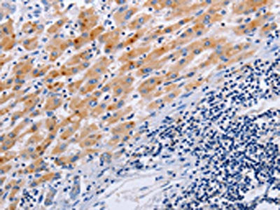The image on the left is immunohistochemistry of paraffin-embedded Human liver cancer tissue using CSB-PA684314(SLC9A3 Antibody) at dilution 1/25, on the right is treated with synthetic peptide. (Original magnification: ×200)