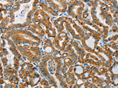 The image on the left is immunohistochemistry of paraffin-embedded Human thyroid cancer tissue using CSB-PA685328(PITX3 Antibody) at dilution 1/15, on the right is treated with synthetic peptide. (Original magnification: ×200)