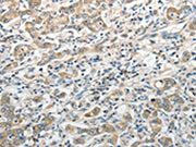 The image on the left is immunohistochemistry of paraffin-embedded Human gastric cancer tissue using CSB-PA686209(PRMT2 Antibody) at dilution 1/20, on the right is treated with fusion protein. (Original magnification: ×200)