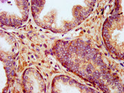 IHC image of CSB-PA686387LA01HU diluted at 1:400 and staining in paraffin-embedded human prostate cancer performed on a Leica BondTM system. After dewaxing and hydration, antigen retrieval was mediated by high pressure in a citrate buffer (pH 6.0)...