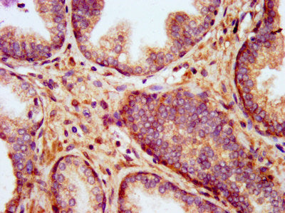 IHC image of CSB-PA686387LA01HU diluted at 1:400 and staining in paraffin-embedded human prostate cancer performed on a Leica BondTM system. After dewaxing and hydration, antigen retrieval was mediated by high pressure in a citrate buffer (pH 6.0)...