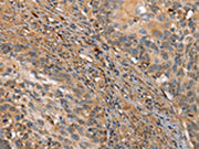 The image on the left is immunohistochemistry of paraffin-embedded Human cervical cancer tissue using CSB-PA687442(HK3 Antibody) at dilution 1/40, on the right is treated with fusion protein. (Original magnification: ×200)