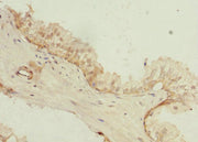 Immunohistochemistry of paraffin-embedded human prostate cancer using CSB-PA687493ESR1HU at dilution of 1:100