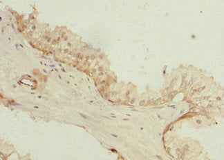 Immunohistochemistry of paraffin-embedded human prostate cancer using CSB-PA687493ESR1HU at dilution of 1:100