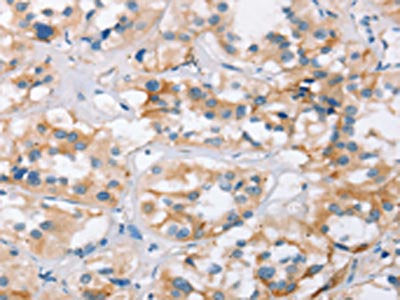 The image on the left is immunohistochemistry of paraffin-embedded Human thyroid cancer tissue using CSB-PA687646(BCAS4 Antibody) at dilution 1/25, on the right is treated with synthetic peptide. (Original magnification: ×200)