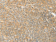 The image on the left is immunohistochemistry of paraffin-embedded Human ovarian cancer tissue using CSB-PA688265(TRPV3 Antibody) at dilution 1/25, on the right is treated with synthetic peptide. (Original magnification: ×200)
