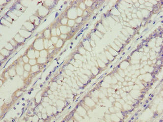 Immunohistochemistry of paraffin-embedded human colon cancer using CSB-PA689332LA01HU at dilution of 1:100