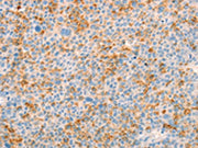 The image on the left is immunohistochemistry of paraffin-embedded Human liver cancer tissue using CSB-PA690154(TRPM7 Antibody) at dilution 1/25, on the right is treated with synthetic peptide. (Original magnification: ×200)