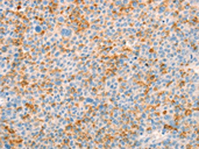 The image on the left is immunohistochemistry of paraffin-embedded Human liver cancer tissue using CSB-PA690154(TRPM7 Antibody) at dilution 1/25, on the right is treated with synthetic peptide. (Original magnification: ×200)