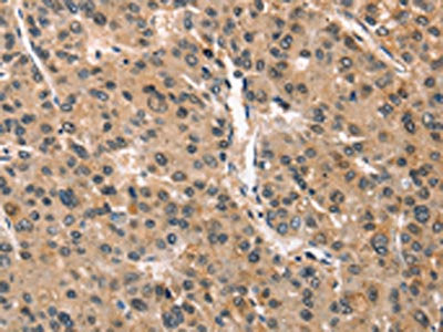 The image on the left is immunohistochemistry of paraffin-embedded Human liver cancer tissue using CSB-PA691668(CRIM1 Antibody) at dilution 1/25, on the right is treated with synthetic peptide. (Original magnification: ×200)