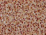 IHC image of CSB-PA692212LA01HU diluted at 1:1600 and staining in paraffin-embedded human glioma performed on a Leica BondTM system. After dewaxing and hydration, antigen retrieval was mediated by high pressure in a citrate buffer (pH 6.0). Sectio...
