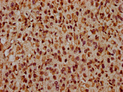 IHC image of CSB-PA692212LA01HU diluted at 1:1600 and staining in paraffin-embedded human glioma performed on a Leica BondTM system. After dewaxing and hydration, antigen retrieval was mediated by high pressure in a citrate buffer (pH 6.0). Sectio...
