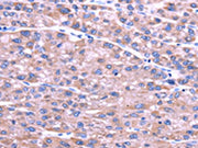 The image on the left is immunohistochemistry of paraffin-embedded Human liver cancer tissue using CSB-PA692718(SENP2 Antibody) at dilution 1/20, on the right is treated with fusion protein. (Original magnification: ×200)