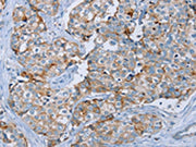 The image on the left is immunohistochemistry of paraffin-embedded Human breast cancer tissue using CSB-PA692815(MUC1 Antibody) at dilution 1/45, on the right is treated with synthetic peptide. (Original magnification: ×200)
