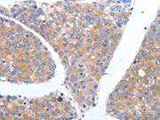 The image on the left is immunohistochemistry of paraffin-embedded Human breast cancer tissue using CSB-PA693066(GFRA4 Antibody) at dilution 1/40, on the right is treated with synthetic peptide. (Original magnification: ×200)