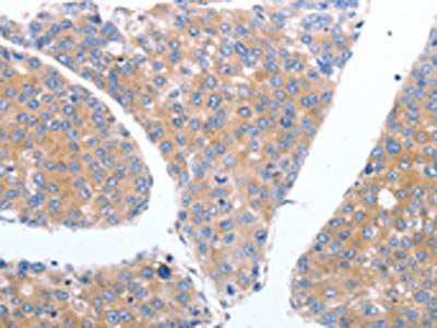 The image on the left is immunohistochemistry of paraffin-embedded Human breast cancer tissue using CSB-PA693066(GFRA4 Antibody) at dilution 1/40, on the right is treated with synthetic peptide. (Original magnification: ×200)
