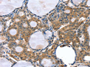 The image on the left is immunohistochemistry of paraffin-embedded Human thyroid cancer tissue using CSB-PA693151(GNAT3 Antibody) at dilution 1/35, on the right is treated with synthetic peptide. (Original magnification: ×200)