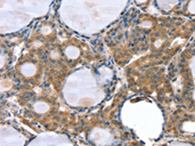The image on the left is immunohistochemistry of paraffin-embedded Human thyroid cancer tissue using CSB-PA693151(GNAT3 Antibody) at dilution 1/35, on the right is treated with synthetic peptide. (Original magnification: ×200)