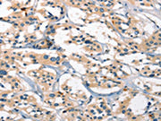 The image on the left is immunohistochemistry of paraffin-embedded Human thyroid cancer tissue using CSB-PA693389(GPR182 Antibody) at dilution 1/25, on the right is treated with synthetic peptide. (Original magnification: ×200)