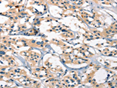 The image on the left is immunohistochemistry of paraffin-embedded Human thyroid cancer tissue using CSB-PA693389(GPR182 Antibody) at dilution 1/25, on the right is treated with synthetic peptide. (Original magnification: ×200)
