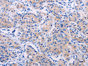 The image on the left is immunohistochemistry of paraffin-embedded Human lung cancer tissue using CSB-PA693559(AGT Antibody) at dilution 1/50, on the right is treated with synthetic peptide. (Original magnification: ×200)