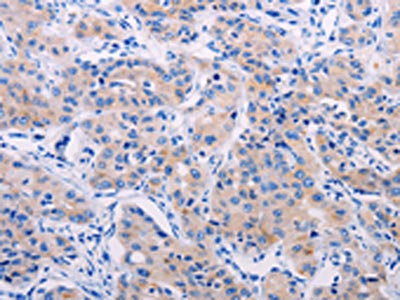 The image on the left is immunohistochemistry of paraffin-embedded Human lung cancer tissue using CSB-PA693559(AGT Antibody) at dilution 1/50, on the right is treated with synthetic peptide. (Original magnification: ×200)