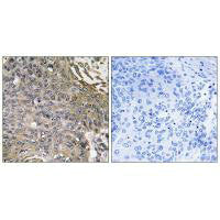 Immunohistochemistry analysis of paraffin-embedded human lung carcinoma tissue using SH2D1B antibody.