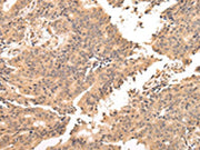 The image on the left is immunohistochemistry of paraffin-embedded Human prostate cancer tissue using CSB-PA693911(USP45 Antibody) at dilution 1/25, on the right is treated with fusion protein. (Original magnification: ×200)