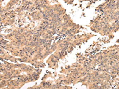 The image on the left is immunohistochemistry of paraffin-embedded Human prostate cancer tissue using CSB-PA693911(USP45 Antibody) at dilution 1/25, on the right is treated with fusion protein. (Original magnification: ×200)