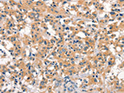 The image on the left is immunohistochemistry of paraffin-embedded Human thyroid cancer tissue using CSB-PA693996(EID3 Antibody) at dilution 1/15, on the right is treated with synthetic peptide. (Original magnification: ×200)