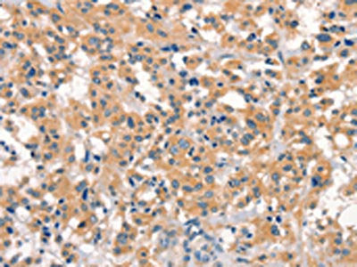 The image on the left is immunohistochemistry of paraffin-embedded Human thyroid cancer tissue using CSB-PA693996(EID3 Antibody) at dilution 1/15, on the right is treated with synthetic peptide. (Original magnification: ×200)