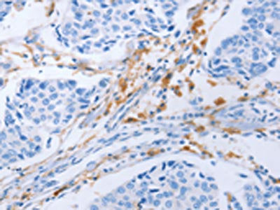 The image on the left is immunohistochemistry of paraffin-embedded Human lung cancer tissue using CSB-PA694004(LAIR1 Antibody) at dilution 1/25, on the right is treated with fusion protein. (Original magnification: ×200)