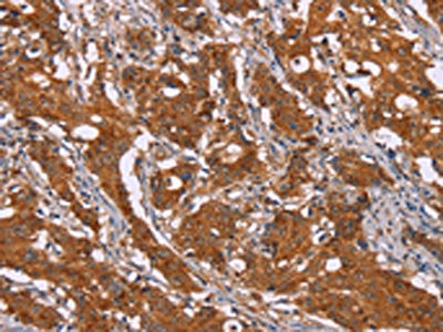 The image on the left is immunohistochemistry of paraffin-embedded Human gastic cancer tissue using CSB-PA694176(DCTN6 Antibody) at dilution 1/40, on the right is treated with fusion protein. (Original magnification: ×200)