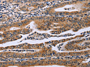 The image on the left is immunohistochemistry of paraffin-embedded Human gastic cancer tissue using CSB-PA694254(FAF1 Antibody) at dilution 1/40, on the right is treated with synthetic peptide. (Original magnification: ×200)
