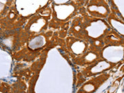 The image on the left is immunohistochemistry of paraffin-embedded Human thyroid cancer tissue using CSB-PA694536(RGS5 Antibody) at dilution 1/40, on the right is treated with fusion protein. (Original magnification: ×200)
