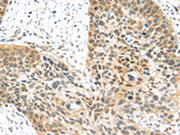The image on the left is immunohistochemistry of paraffin-embedded Human esophagus cancer tissue using CSB-PA694564(MET Antibody) at dilution 1/25, on the right is treated with synthetic peptide. (Original magnification: ×200)