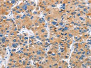 The image on the left is immunohistochemistry of paraffin-embedded Human liver cancer tissue using CSB-PA694579(DKK2 Antibody) at dilution 1/60, on the right is treated with fusion protein. (Original magnification: ×200)
